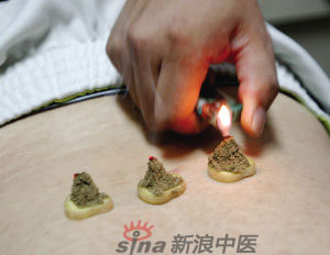 灸法的種類  你知道多少？
